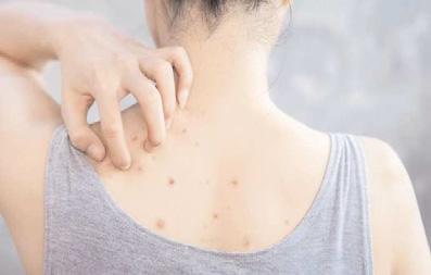 Bacne, or back acne, can be embarrassing. How to deal with it?