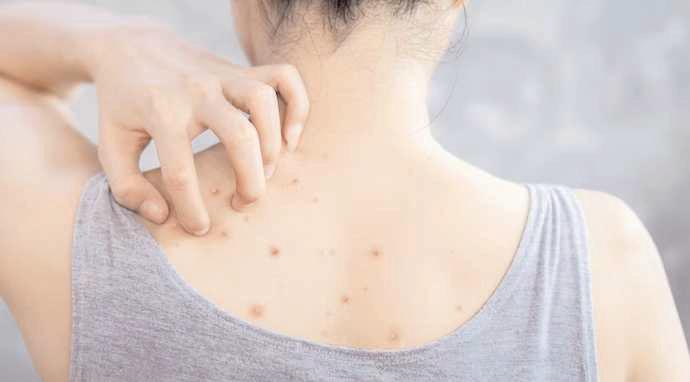 Bacne, or back acne, can be embarrassing. How to deal with it?