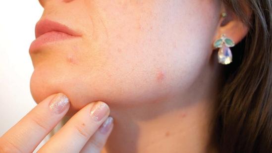 BEATING ACNE NATURALLY: AYURVEDA HERBS, HOMEOPATHY TIPS AND 6 LIFESTYLE CHANGES TO DETOX YOUR SKIN