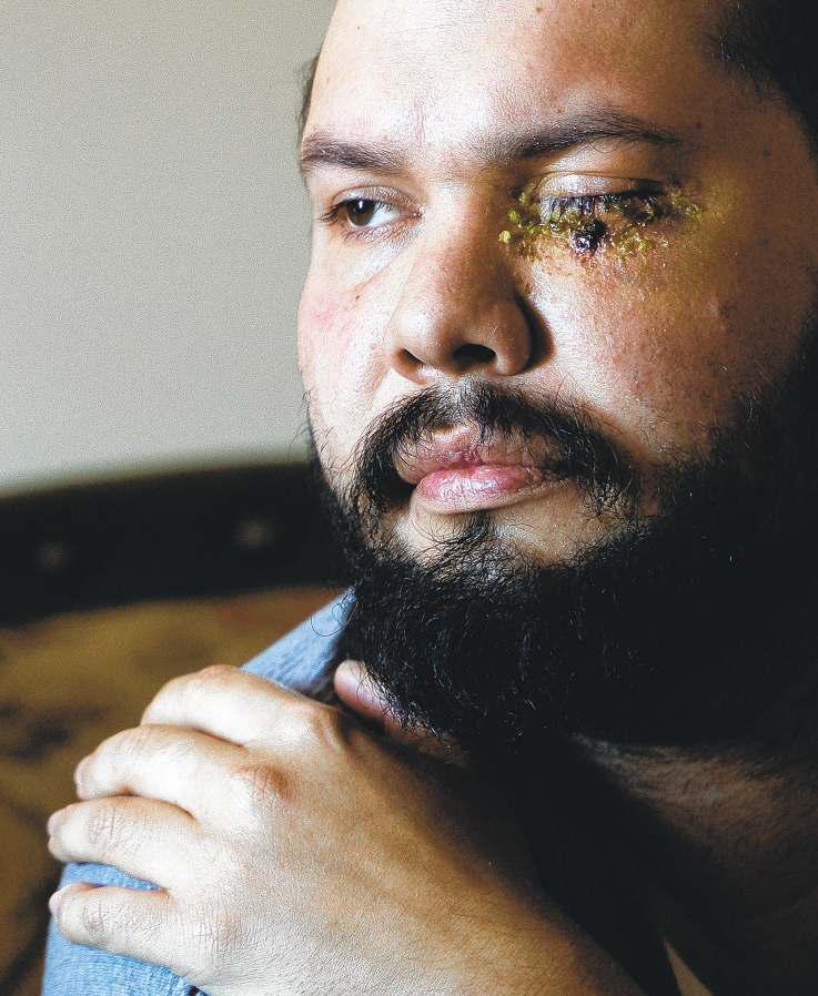 Second man alleges he was blinded at rally