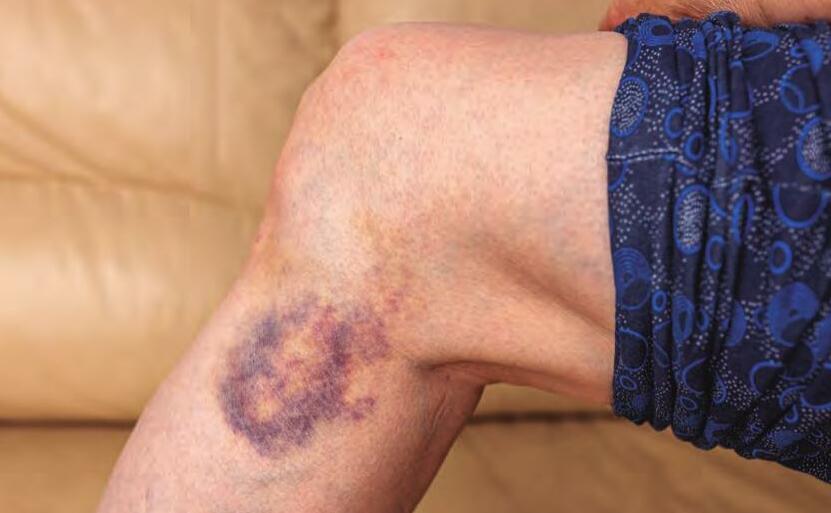 Moretones que se forman con facilidad